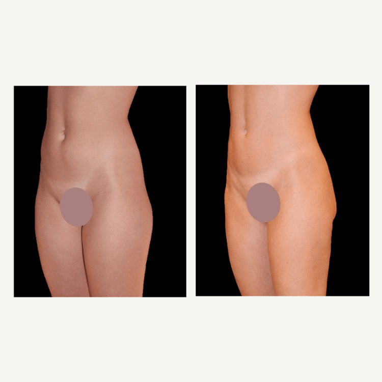 Photos 3/4 gauche cuisses, hanches, abdomen, taille de femme avant-après lipoaspiration réalisée par Dr Olivier CLAUDE