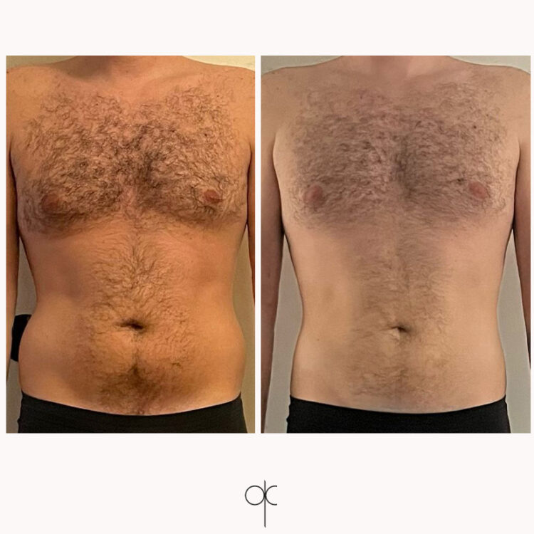 coolsculpting 1