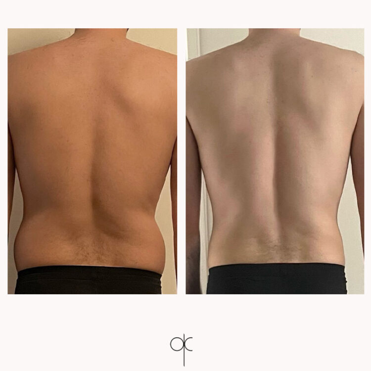 coolsculpting 2