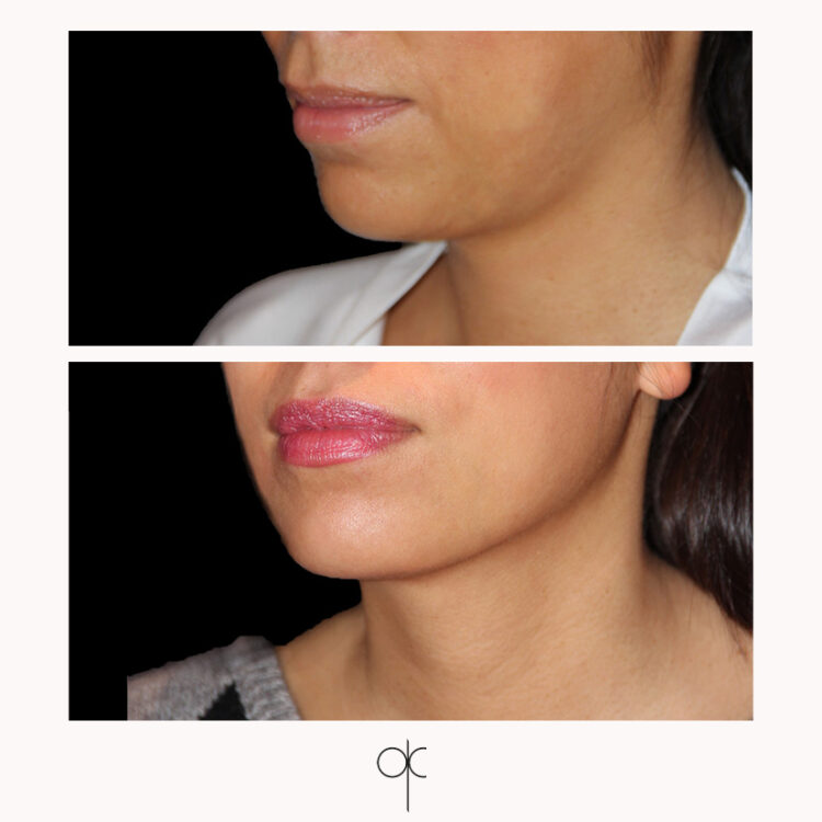 Photos de profil visage de femme, avant et après intervention esthétique du visage réalisée par le Dr Olivier CLAUDE