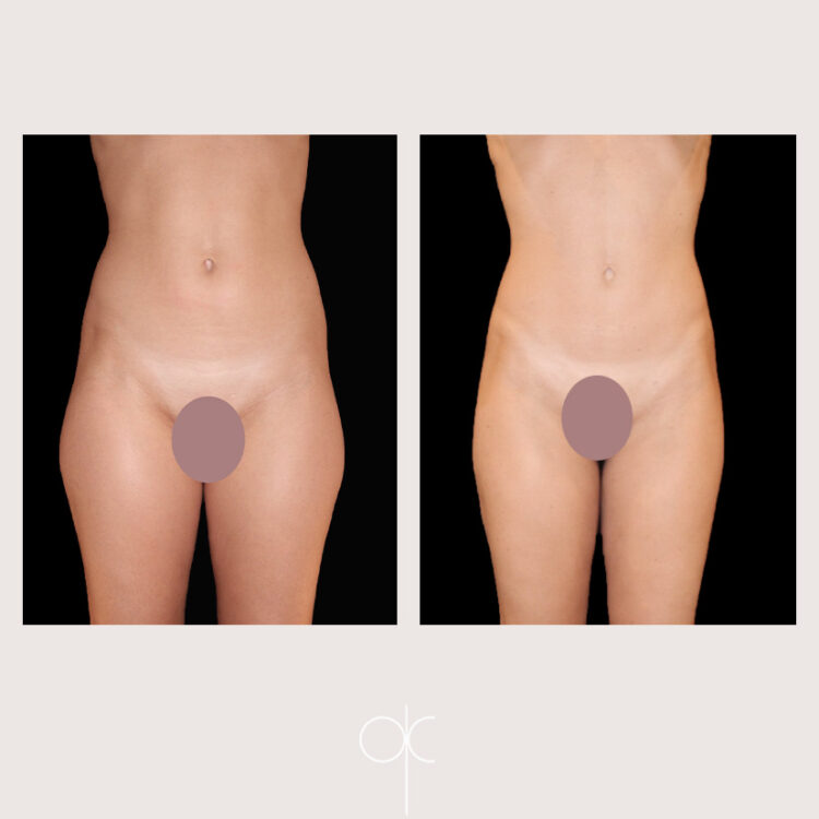 Photos de face cuisses, hanches, abdomen, taille femme avant-après lipoaspiration réalisée par Docteur Olivier CLAUDE