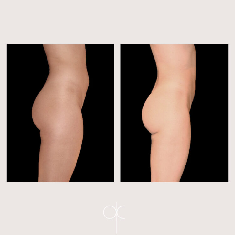 Photos de profil cuisses fesses taille abdomen dos femme avant-après lipoaspiration réalisée par Dr Olivier CLAUDE