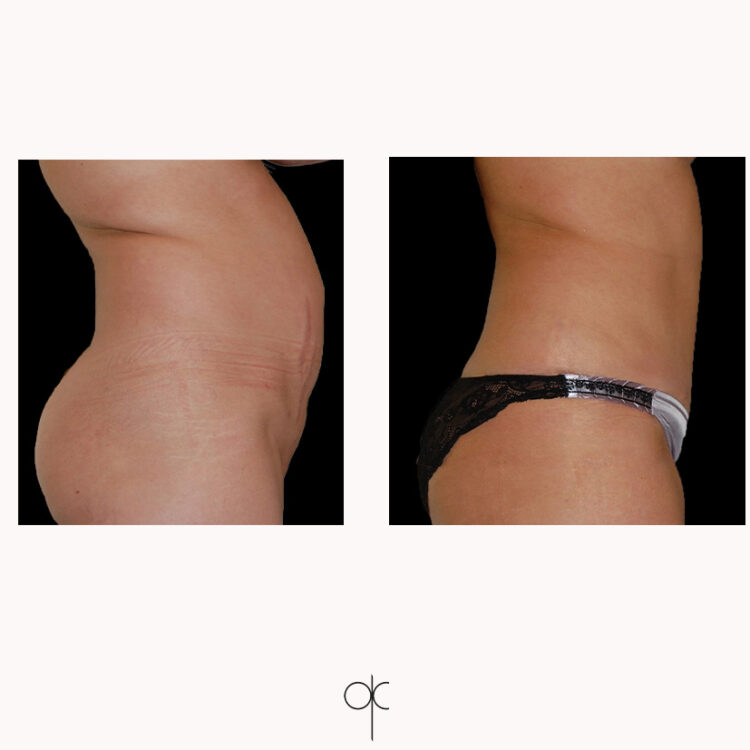 Photos profil fesses hanches taille abdomen femme avant-après lipoaspiration réalisée par Dr Olivier CLAUDE