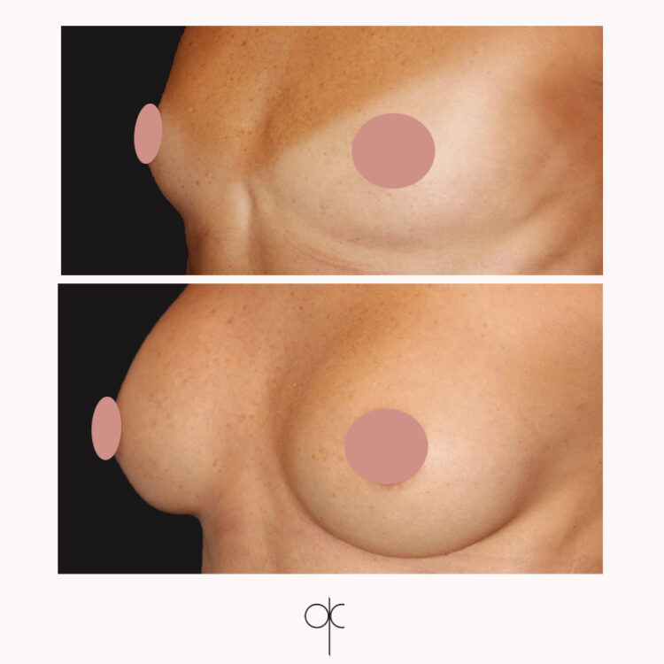 Docteur Claude avant après prothèses mammaires 3