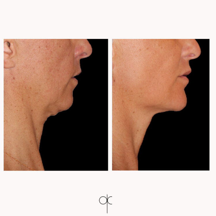 Photos de profil menton et oval visage de femme avant-après intervention de médecine esthétique du Dr Olivier CLAUDE