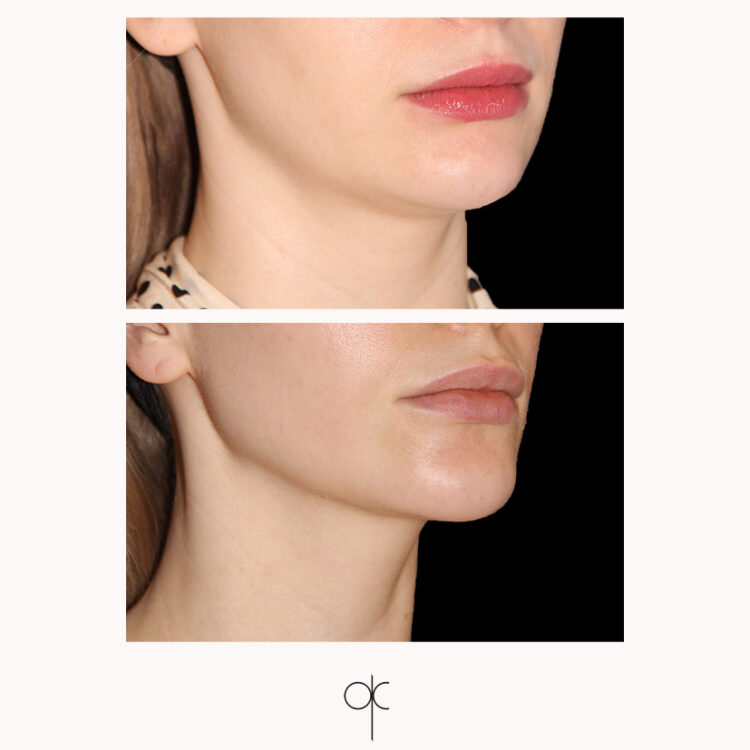 Photos de 3/4 menton et oval visage de femme avant-après intervention de médecine esthétique du Dr Olivier CLAUDE