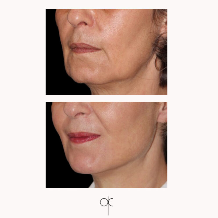 Photos de 3/4 de menton et oval de visage de femme avant-après intervention de médecine esthétique du Dr Olivier CLAUDE