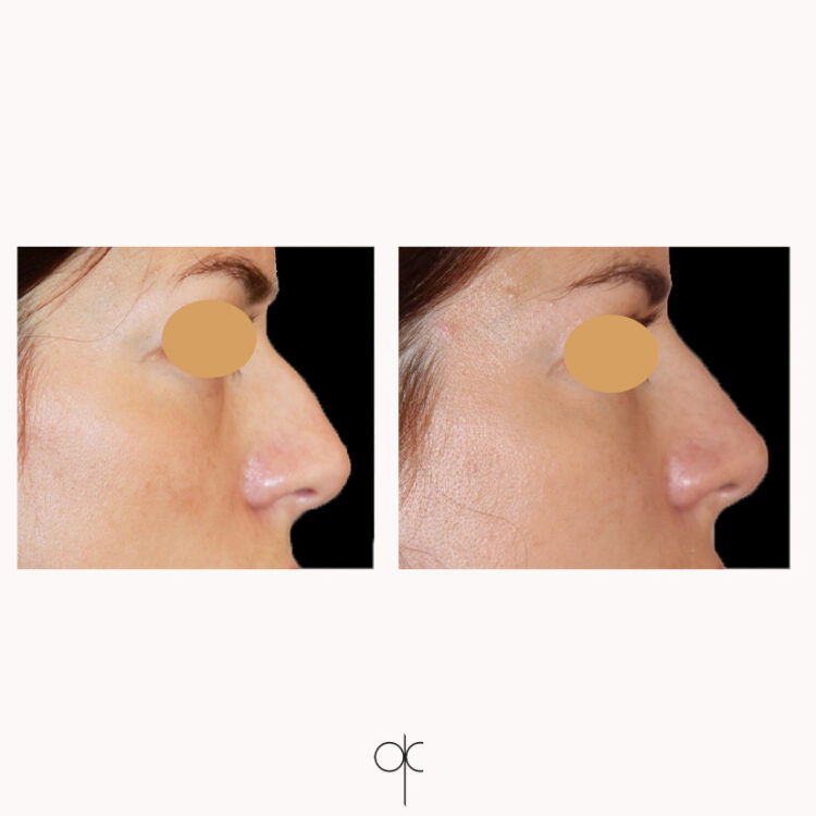 Photos de profil de femme avant-après rhinoplastie médicale réalisée par le Dr Olivier CLAUDE