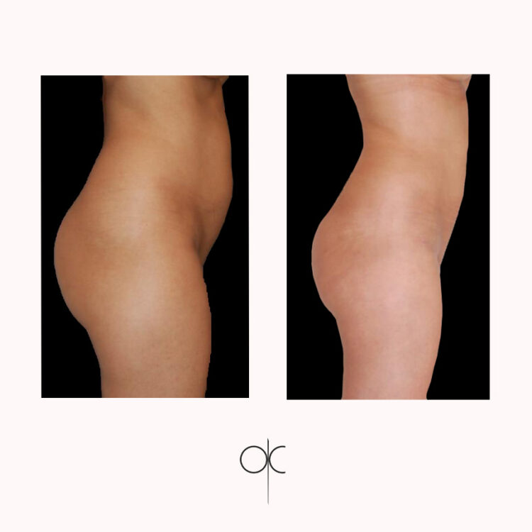 Photos profil droit cuisses fesses hanches taille abdomen femme avant-après lipoaspiration réalisée par Dr Olivier CLAUDE