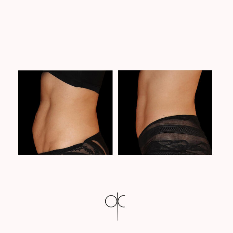 Photo de 3/4 abdomen femme en sous-vêtements noirs avant-après Cryolipolyse Coolsculpting réalisée par le Dr Olivier CLAUDE