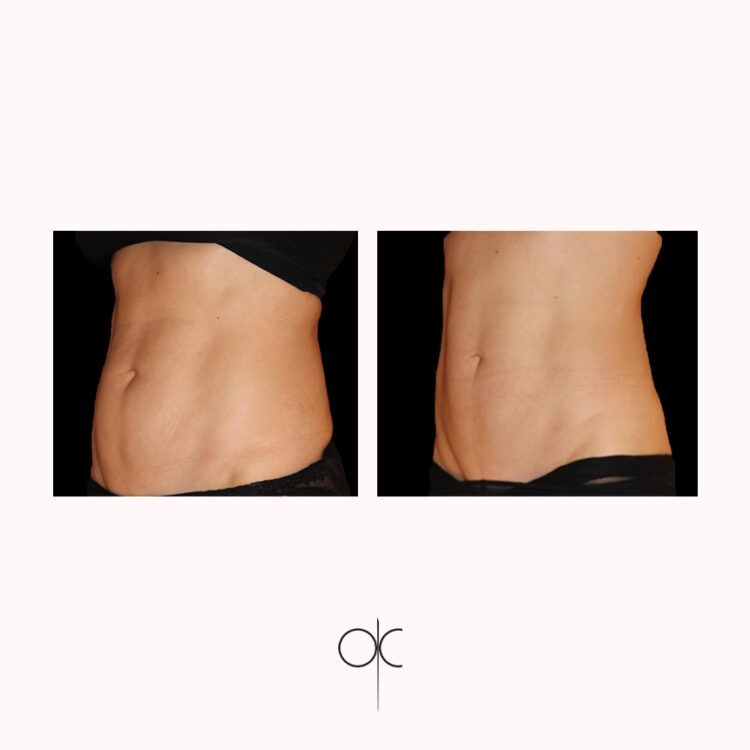 Photo profil silhouette femme en sous-vêtements noirs avant-après Cryolipolyse Coolsculpting réalisée par Dr Olivier CLAUDE