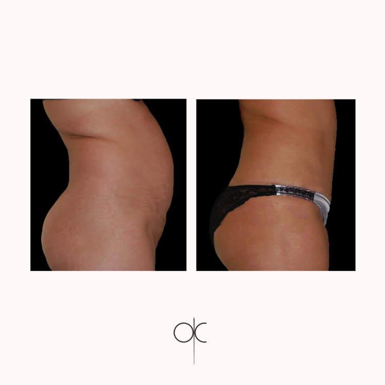 Photos de profil des fesses, hanches, taille et abdomen de femme avant-après abdominoplastie réalisée par Dr Olivier CLAUDE