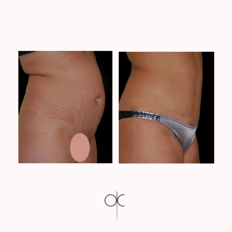 Photos de 3/4 des cuisses, hanches, taille, abdomen, femme avant-après abdominoplastie réalisée par Dr Olivier CLAUDE