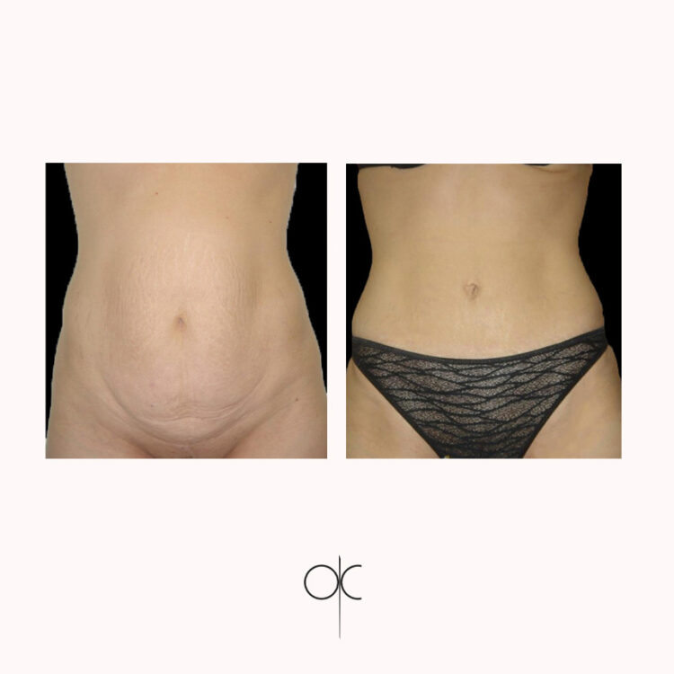 Photos de face des hanches, taille, abdomen de femme avant-après abdominoplastie réalisée par Dr Olivier CLAUDE