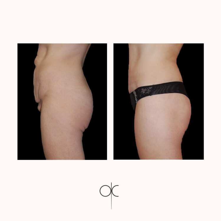 Photos de profil de femme en sous-vêtements noirs, avant-après bodylift réalisé par Dr Olivier CLAUDE