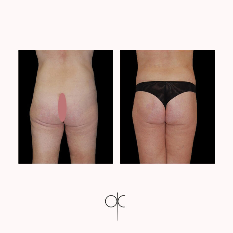 Photos de dos de femme en sous-vêtements noirs, avant-après bodylift réalisé par Dr Olivier CLAUDE