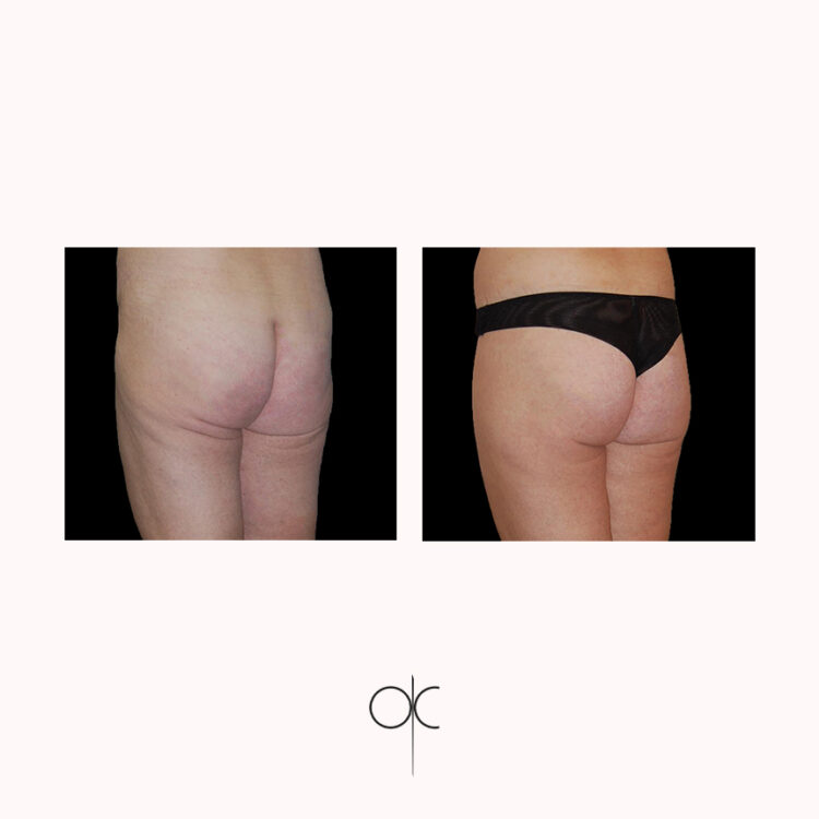 Photos de 3/4 de femme en sous-vêtements noirs, avant-après bodylift réalisé par Dr Olivier CLAUDE