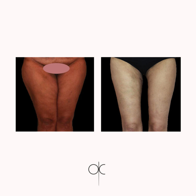 Photos de face de femme en culotte noire, avant-après lifting des cuisses réalisé par le Dr Olivier CLAUDE