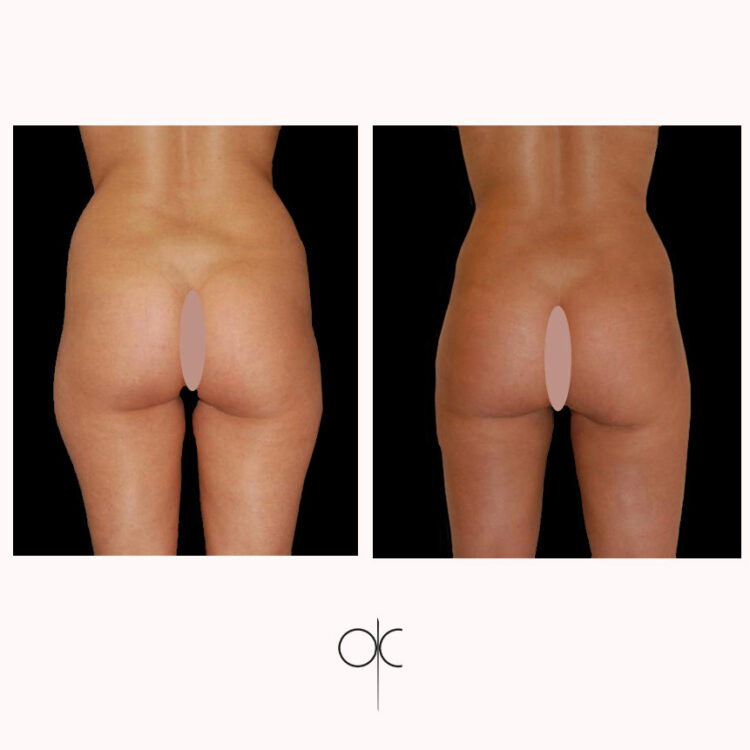 Photos de dos cuisses, fesses, hanches, taille, dos de femme avant-après lipoaspiration réalisée par Dr Olivier CLAUDE