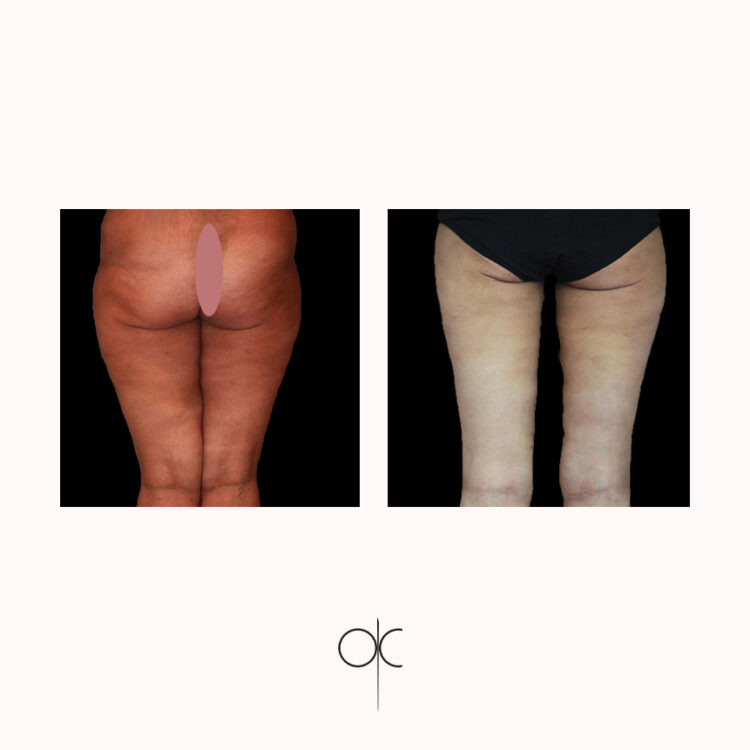 Photos de dos de femme en culotte noire, avant-après lifting des cuisses réalisé par le Dr Olivier CLAUDE
