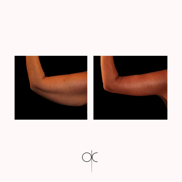 Photos de bras relevé d'une femme bronzée, avant-après lifting des bras réalisé par le Dr Olivier CLAUDE