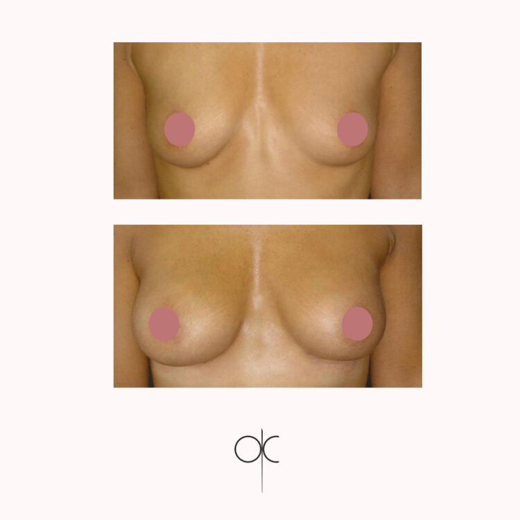 Photo de face de poitrine de femme menue, avant-après pose de prothèses mammaires réalisée par le Dr Olivier CLAUDE