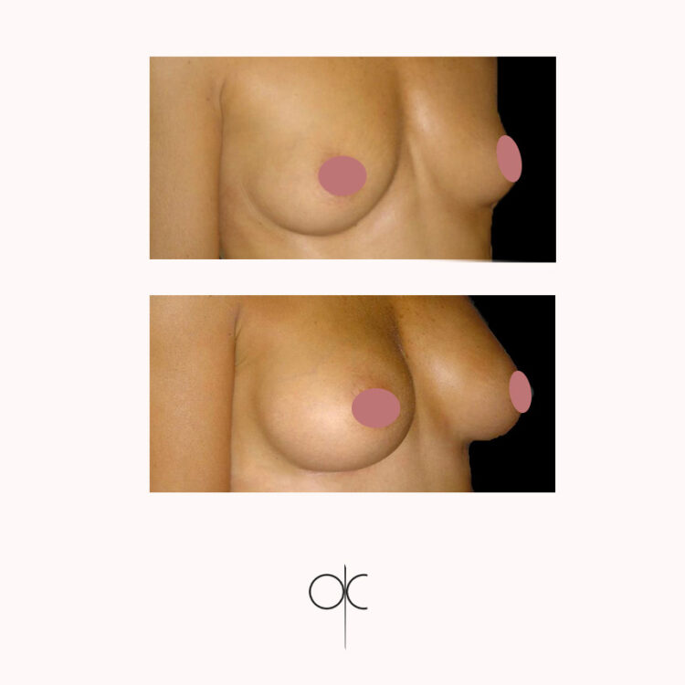 Photo de 3/4 de poitrine de femme menue, avant-après pose de prothèses mammaires réalisée par le Dr Olivier CLAUDE