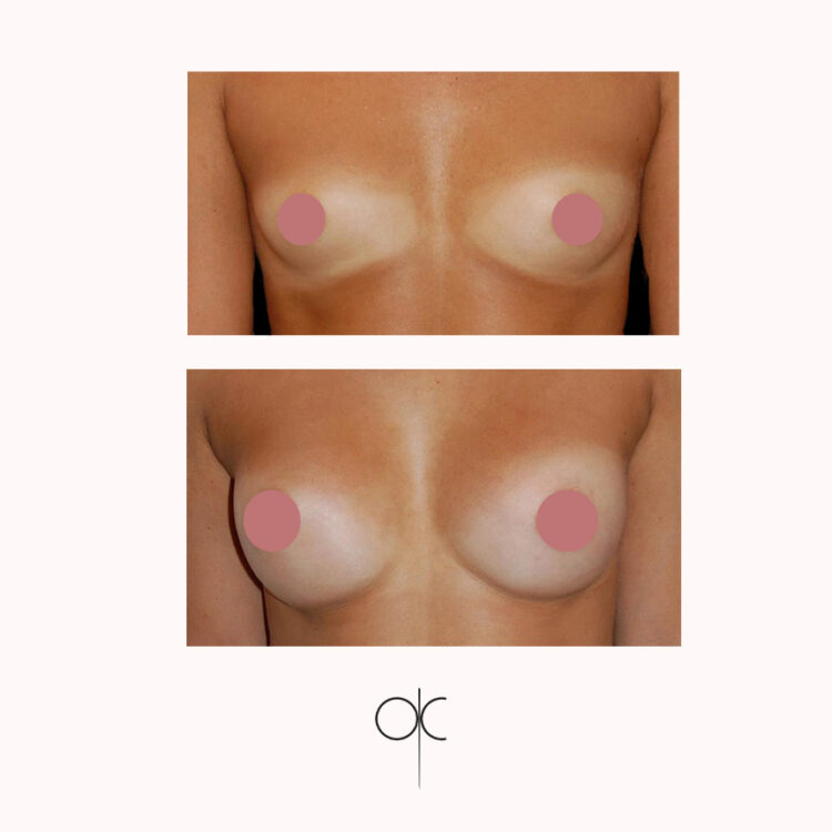 Photo de face de poitrine de femme bronzée, avant-après pose de prothèses mammaires réalisée par le Dr Olivier CLAUDE