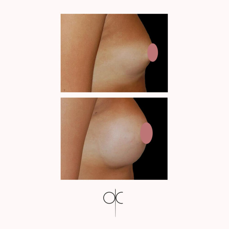 Photo de profil de poitrine de femme bronzée, avant-après pose de prothèses mammaires réalisée par le Dr Olivier CLAUDE