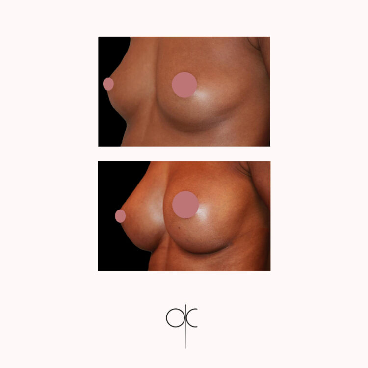 Photo de 3/4 de poitrine de femme peau mate, avant-après pose de prothèses mammaires réalisée par le Dr Olivier CLAUDE