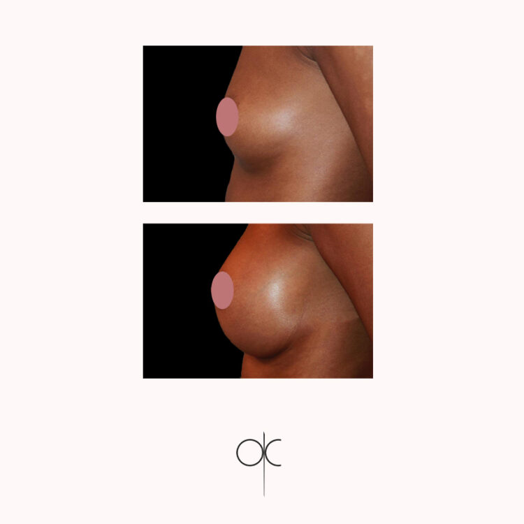 Photo de profil de poitrine de femme peau mate, avant-après pose de prothèses mammaires réalisée par le Dr Olivier CLAUDE