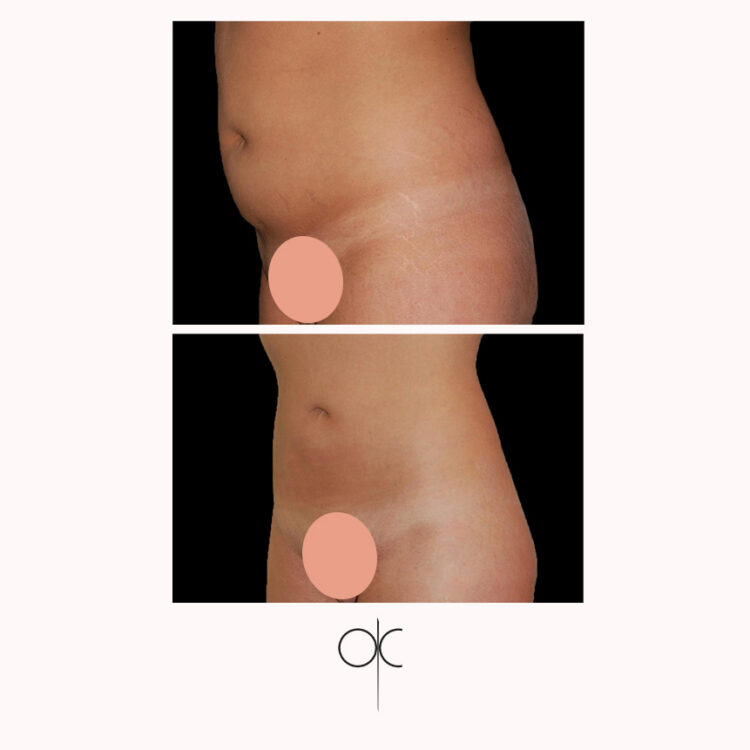 Photos 3/4 gauche fesses hanches taille abdomen femme peau mâte avant-après lipoaspiration réalisée par Dr Olivier CLAUDE
