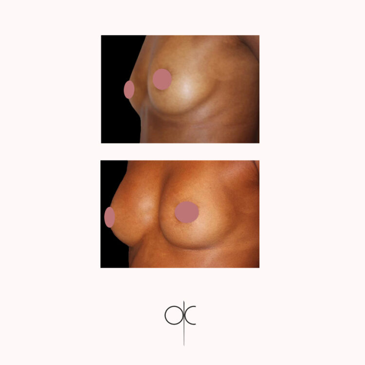 Photo 3/4 de poitrine de femme mince à peau mate, avant-après pose de prothèses mammaires réalisée par le Dr Olivier CLAUDE