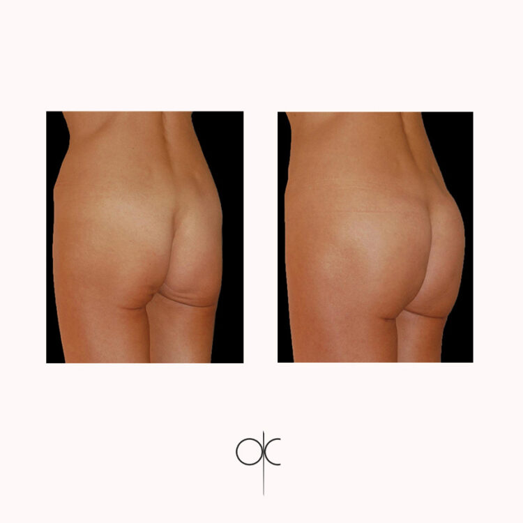 Photos de 3/4 de silhouette avant-après intervention esthétique de la région fessière, par le Dr Olivier CLAUDE