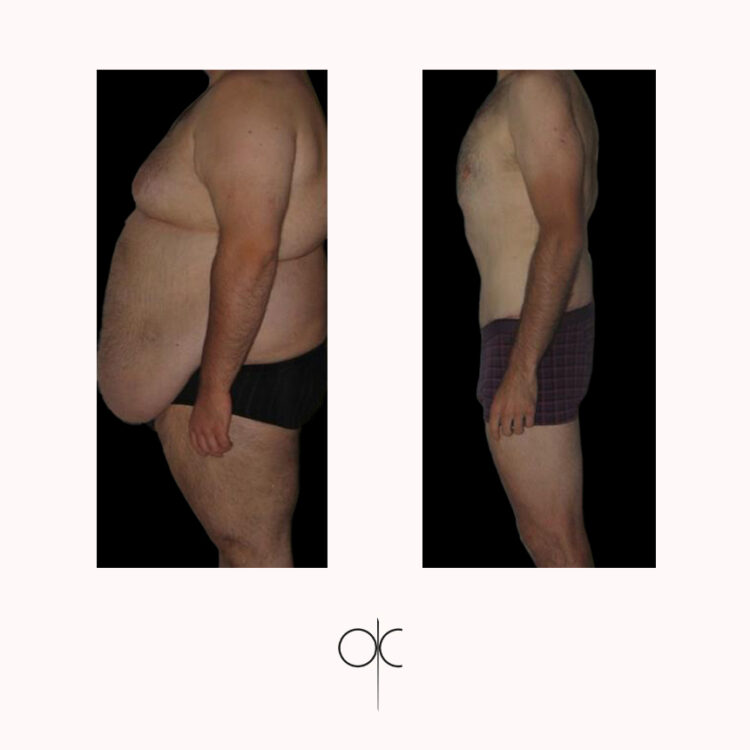 Photos de profil d'homme en caleçon, avant-après bodylift réalisé par Dr Olivier CLAUDE
