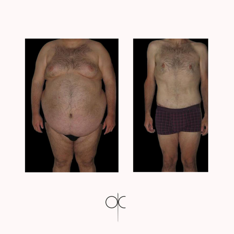 Photos de face d'homme en caleçon, avant-après bodylift réalisé par Dr Olivier CLAUDE