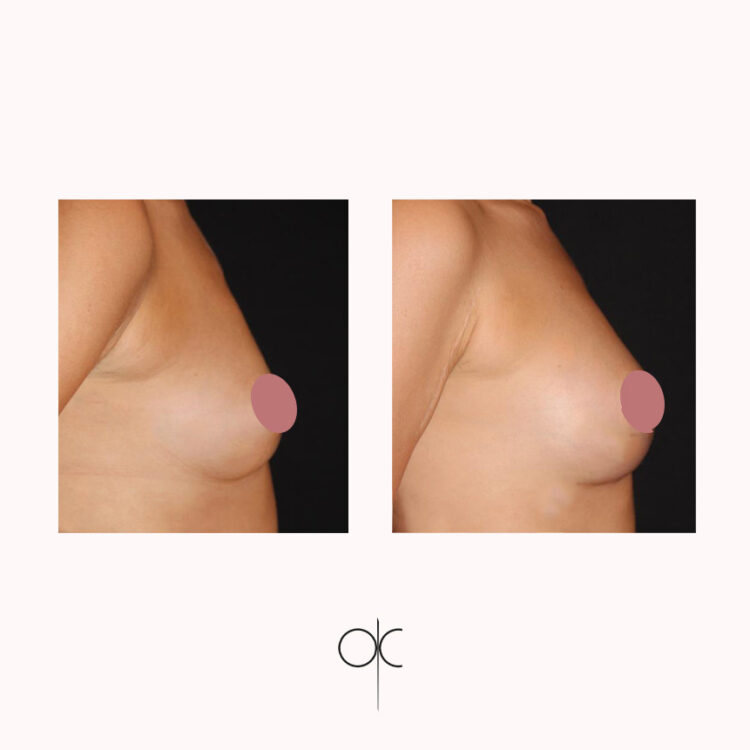 Photo de profil de poitrine de femme menue, avant-après lipofilling mammaire réalisé par le Dr Olivier CLAUDE