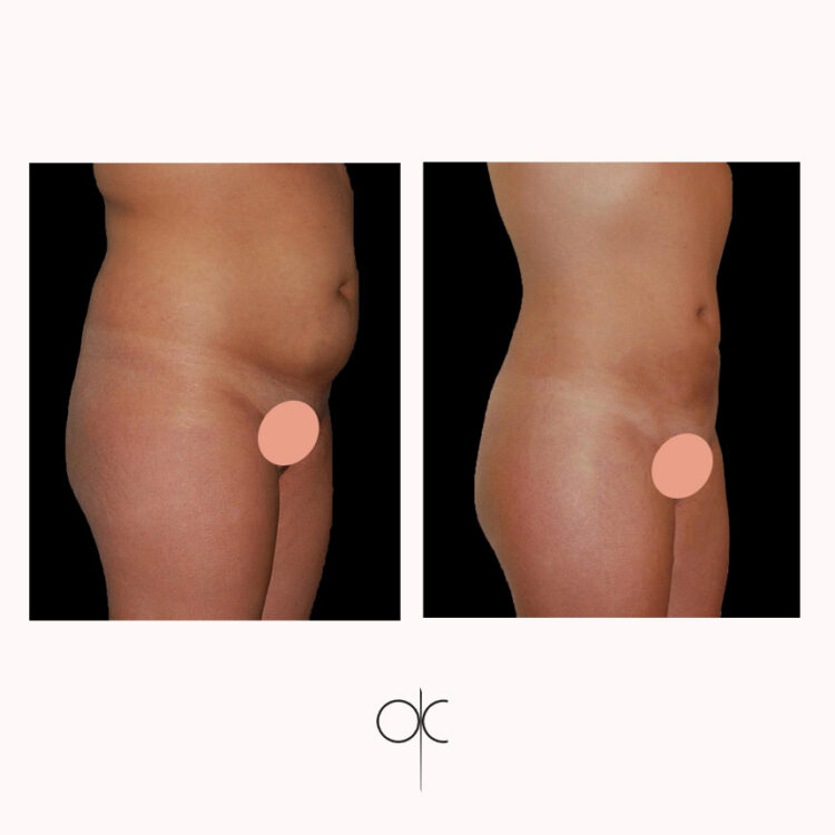 Photos 3/4 droite fesses hanches taille abdomen femme peau mâte avant-après lipoaspiration réalisée par Dr Olivier CLAUDE