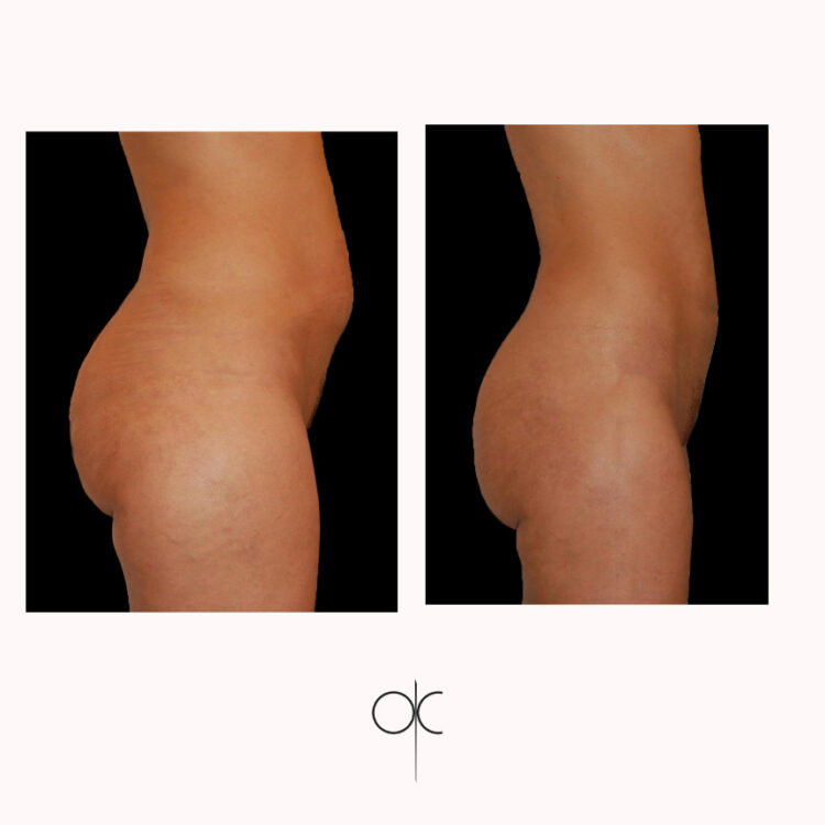 Photos de profil cuisses fesses taille abdomen femme cambrée avant-après lipoaspiration réalisée par Dr Olivier CLAUDE