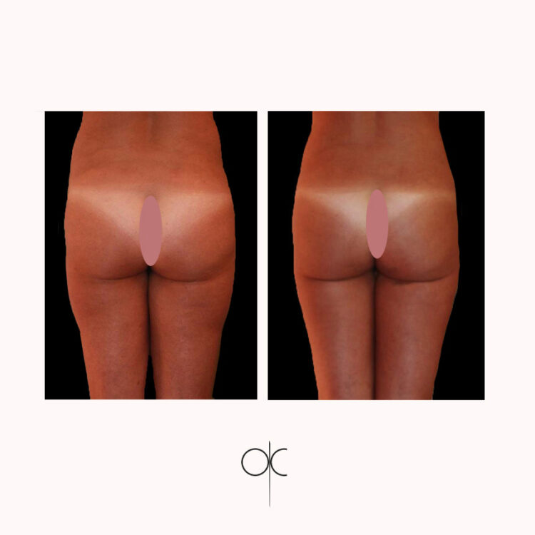 Photos de dos cuisses fesses hanches taille de femme bronzée avant-après lipoaspiration réalisée par Dr Olivier CLAUDE