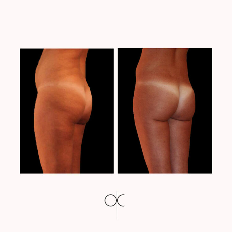 Photos 3/4 cuisses, fesses, hanches, taille de femme bronzée avant-après lipoaspiration réalisée par Dr Olivier CLAUDE