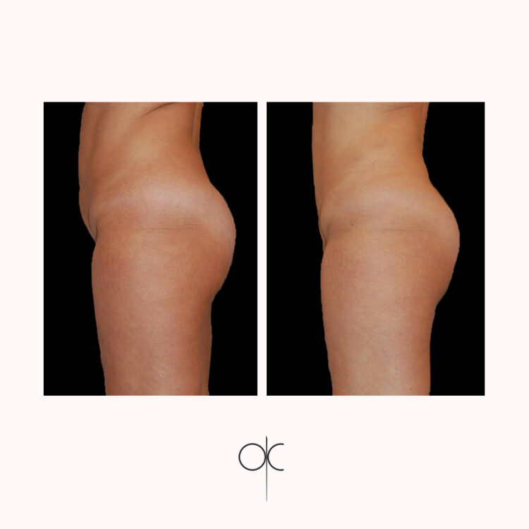 Photos profil droit cuisses fesses hanches taille abdomen femme avant-après lipoaspiration réalisée par Dr Olivier CLAUDE