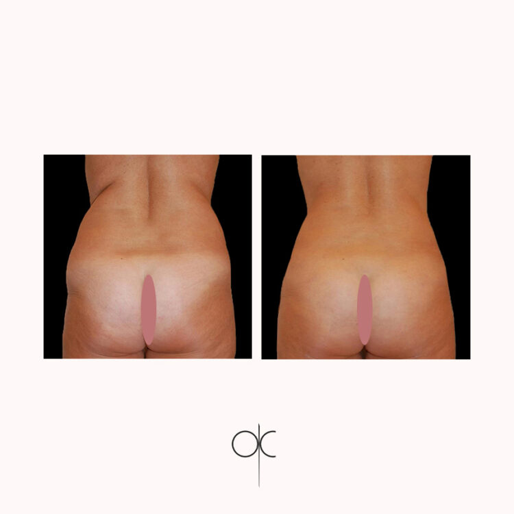Photos de dos des fesses, hanches, taille et dos de femme avant-après lipoaspiration réalisée par le Dr Olivier CLAUDE