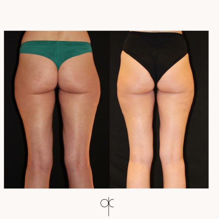 Photo de dos des jambes, fesses et taille de femme, vant-après Cryolipolyse Coolsculpting réalisée par le Dr Olivier CLAUDE